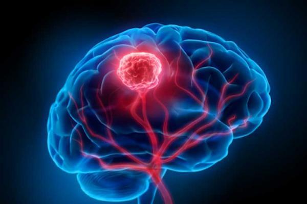 انواع جراحی در درمان تومورهای مغزی