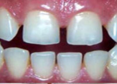درمان فاصله های بین دندانی